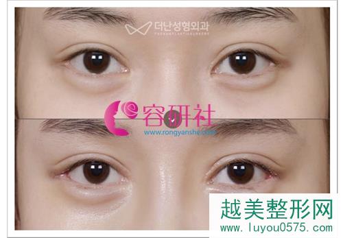 韩国Thenan医院眼睛修复案例