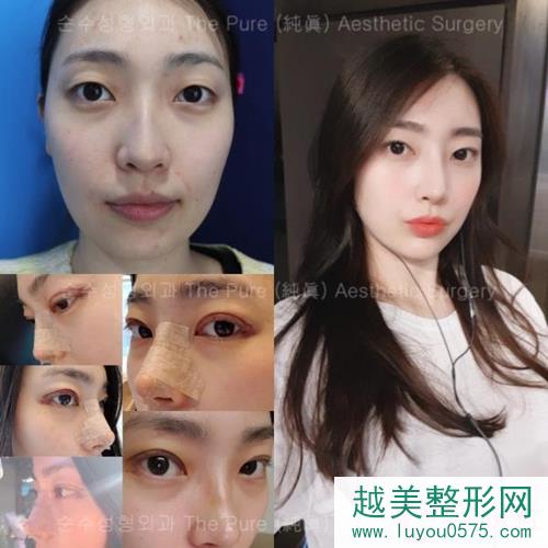 韩国纯真整形外科眼鼻部手术案例