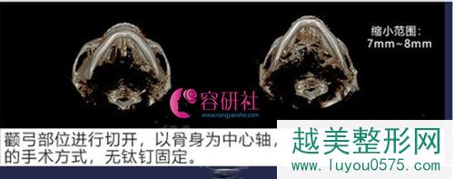 韩国绮林整形医院面部轮廓手术果——3d颧骨缩小术