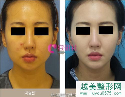 韩国迪美丽整形外科v脸吸脂案例