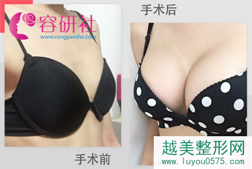 韩国NANA整形医院双平面plus隆胸对胸部下垂果好吗?