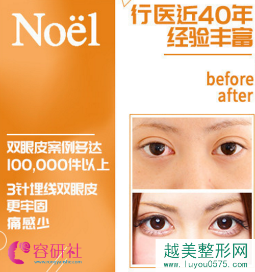 日本Noel银座美容整形医院保志名胜医生双眼皮手术案例