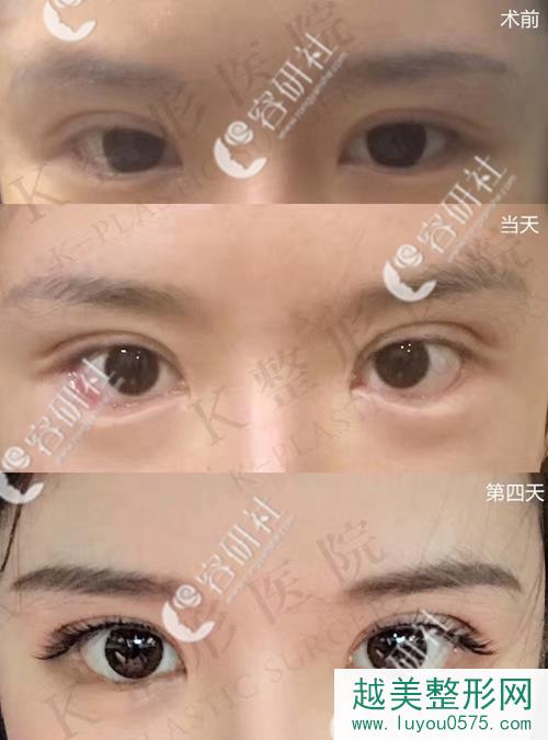 韩国k整形医院外眼角下zhi糖果眼角案例恢复过程图