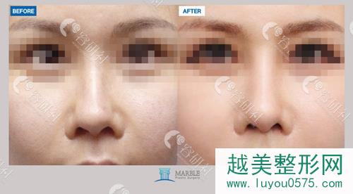 韩国玛博尔整形外科鼻修复手术案例