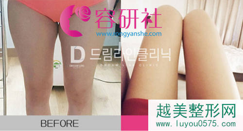 韩国梦线Dreamline整形外科大腿环吸案例