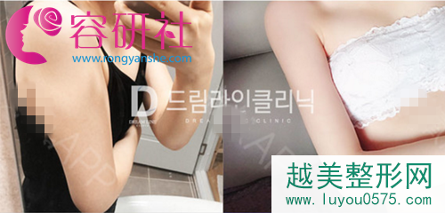 韩国梦线Dreamline整形外科手臂吸脂案例