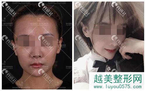北京联合丽格师俊莉鼻部手术案例