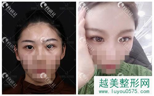 北京联合丽格王岩眼部手术案例