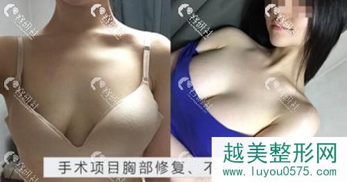 韩国丽珍整形医院假体隆胸案例
