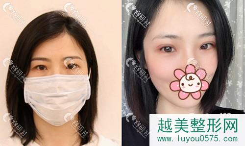 北京丰联丽格眼整形修复中心双眼皮案例