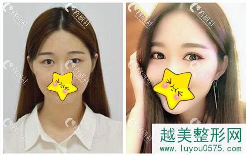 北京美诗沁世茂医疗美容诊所双眼皮案例