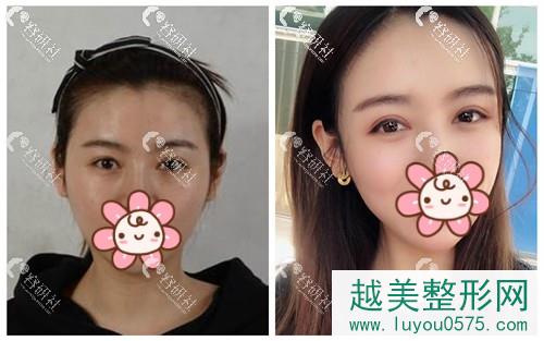 北京美莱医疗美容医院双眼皮案例