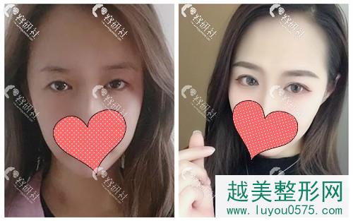 北京爱悦丽格医疗美容诊所双眼皮案例