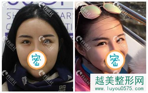 北京新星靓医疗美容医院双眼皮案例