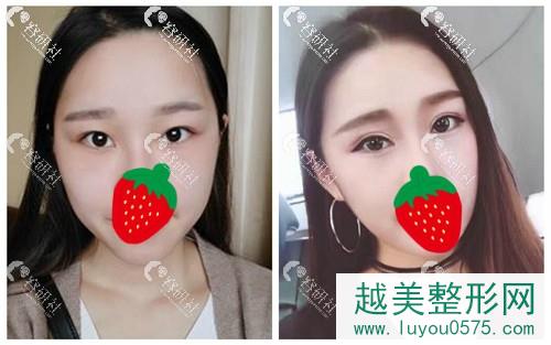 北京艾菲医疗美容诊所双眼皮案例