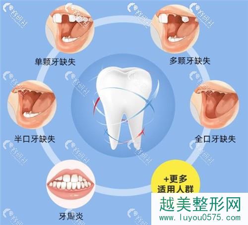 上海中博口腔医院种植牙适应人群