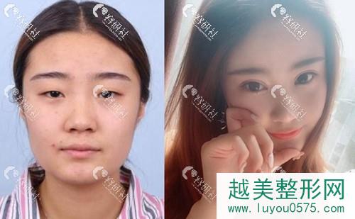 昆山米扬丽格医疗美容门诊部全切双眼皮手术案例