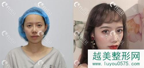 天津伊美尔医疗整形美容专科医院双眼皮案例