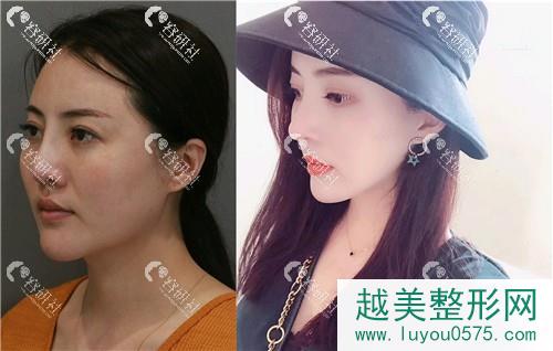 北京米扬丽格医疗美容巫文云假体隆鼻修复案例