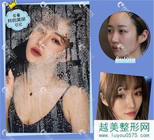 北京米扬丽格医疗美容巫文云肋软骨鼻修复案例