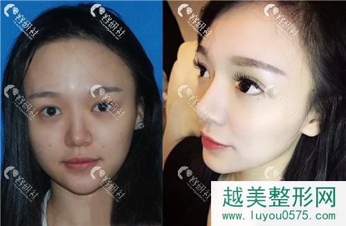 北京米扬丽格医疗美容巫文云鼻修复前后对比照