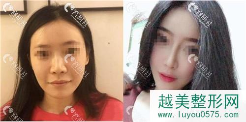 北京米扬丽格医疗美容巫文云假体隆鼻修复对比案例图