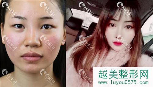 上海艺星医疗美容医院双眼皮前后对比照