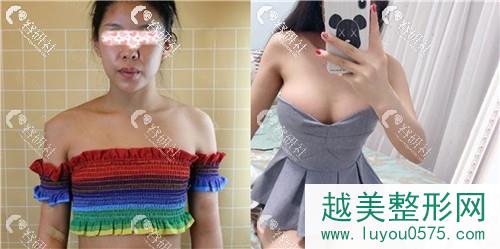 上海艺星医疗美容医院彭才学隆胸对比图