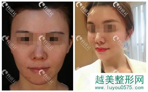上海薇琳医疗美容医院面部提升案例