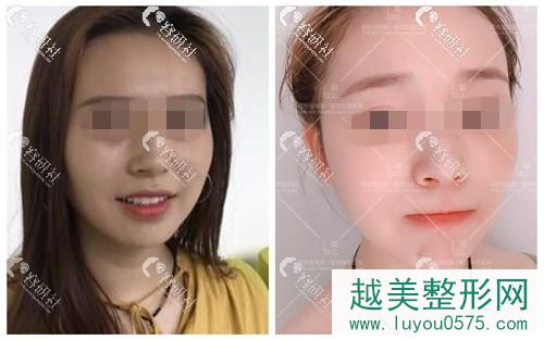 北京联合丽格医疗美容医院面部提升案例