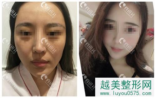 上海百达丽医疗美容门诊部面部提升案例