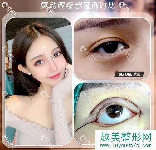 上海千美整形医院灵动眼部手术案例对比图