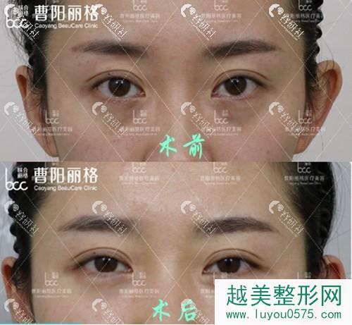 重庆曹阳丽格医疗美容诊所眼袋整形案例