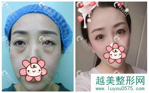 北京百达丽医疗美容门诊部余东眼袋手术案例