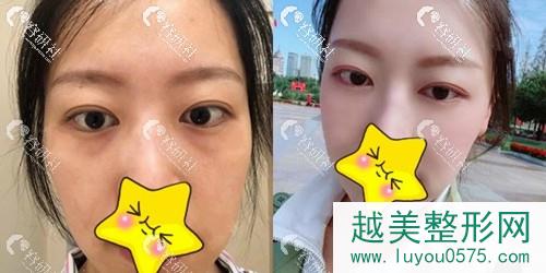 北京华悦府医疗美容诊所眼袋整形案例