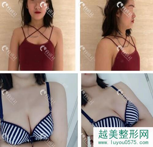 杭州艺星医疗美容医院付德刚假体隆胸案例