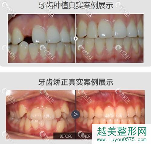 西安海涛口腔牙齿矫正、种植牙案例