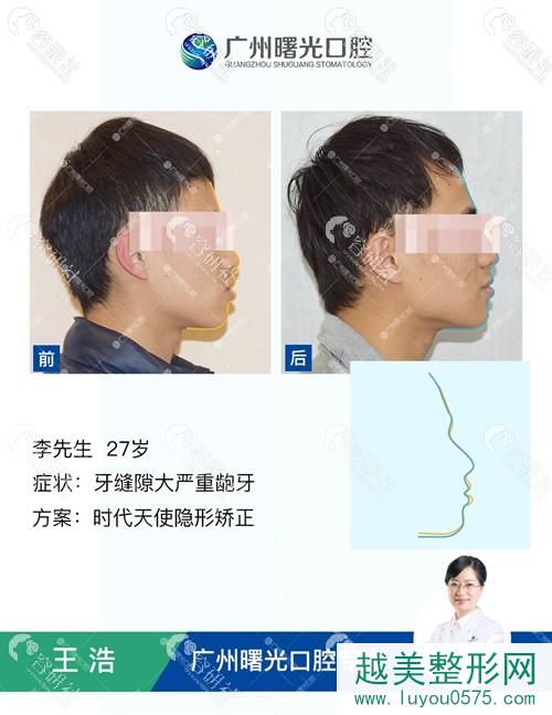 广州曙光口腔龅牙矫正案例照片