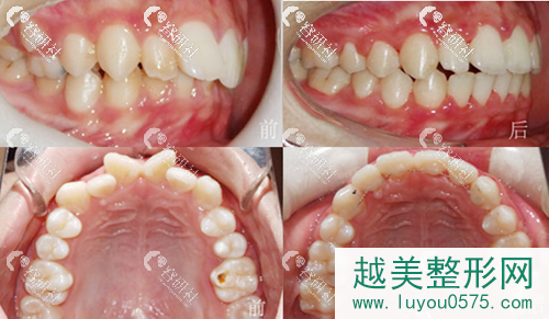 北京国医康口腔牙齿矫正案例