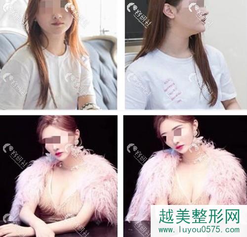广州美莱医疗美容李高峰假体隆胸案例