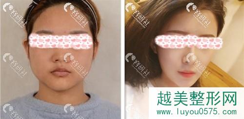 上海欧莱美医疗美容医院鼻整形案例