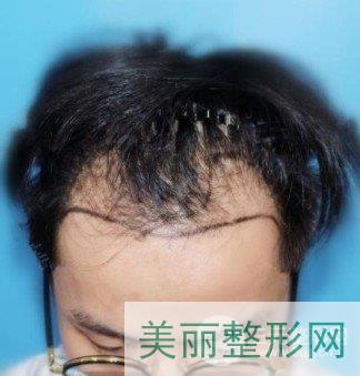 北京女性植发医院
