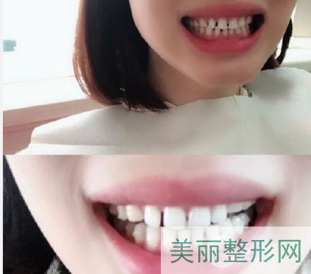 北京积水潭医院牙齿矫正多少钱