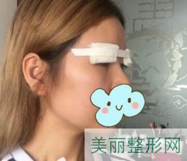 重庆新桥医院割双眼皮案例图