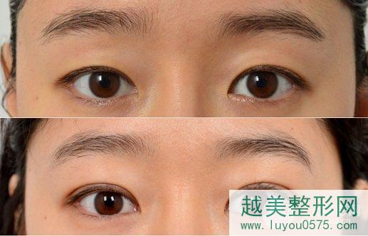 重庆医科大学附属第一医院整形科双眼皮案例图