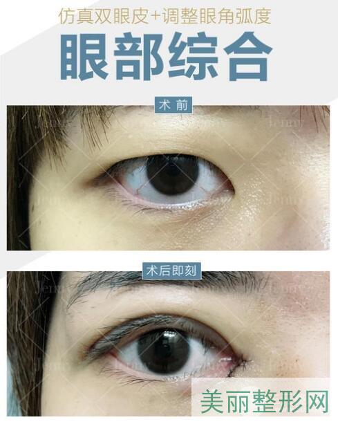 湖南省人民医院整形外科双眼皮案例图