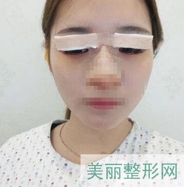 上海lj医美怎么样？小姐姐的日式微创双眼皮果图