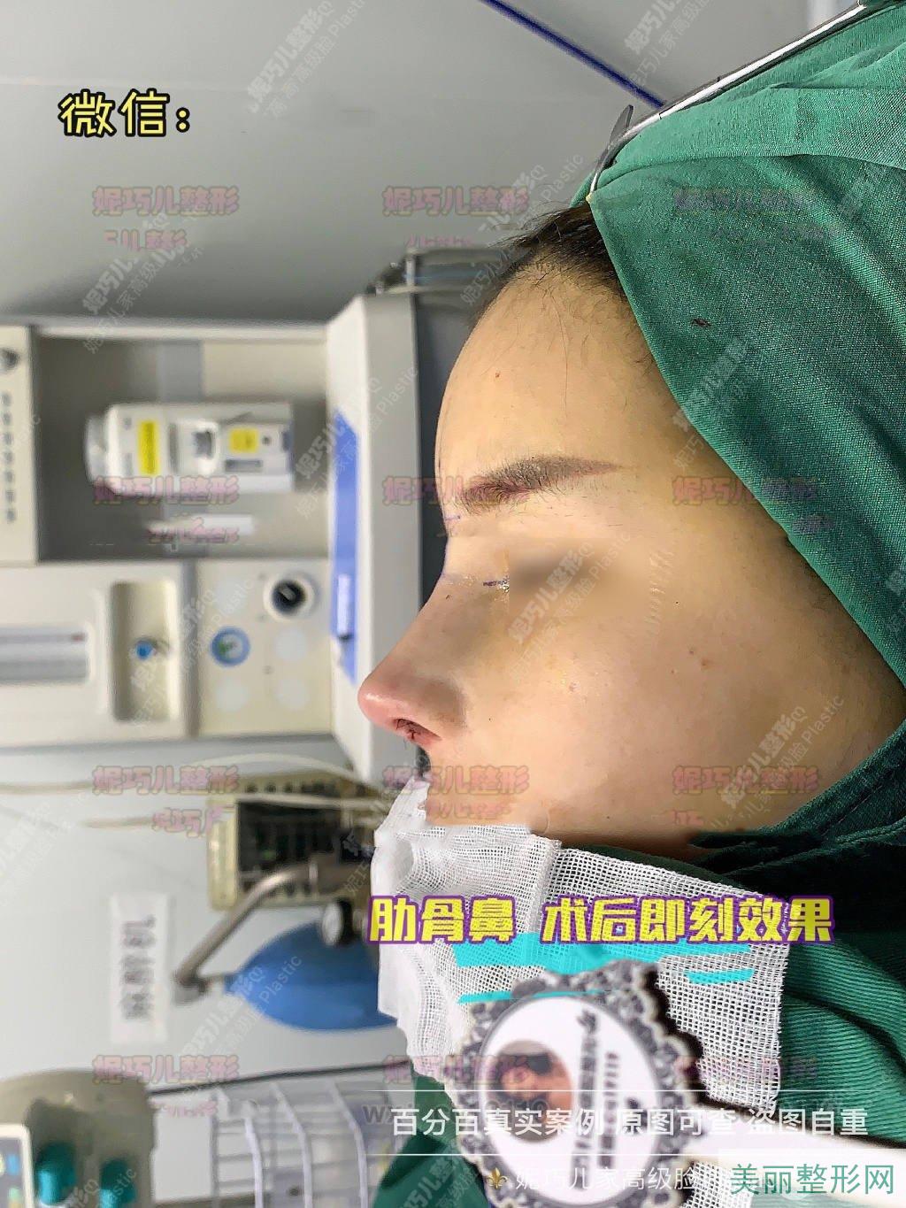 上海妮巧儿医疗美容整形医院芭比肋软骨隆鼻案例图