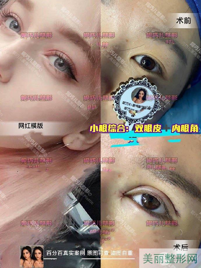 上海妮巧儿医疗美容整形医院网红风双眼皮案例（图）