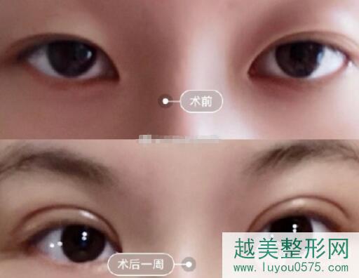 湘雅三医院整形科双眼皮案例